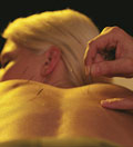 acupuncture treatments